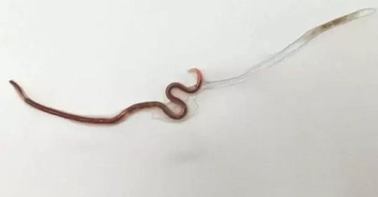 Woman complains of throat pain, doctors find 3.8 centimetre-long worm in her tonsil