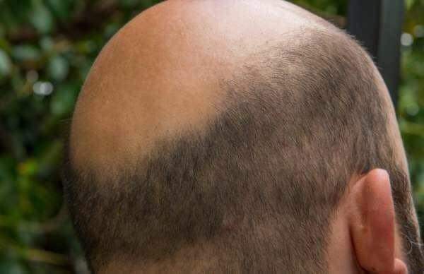 Newly married man hides bald head with wig, wife files police case