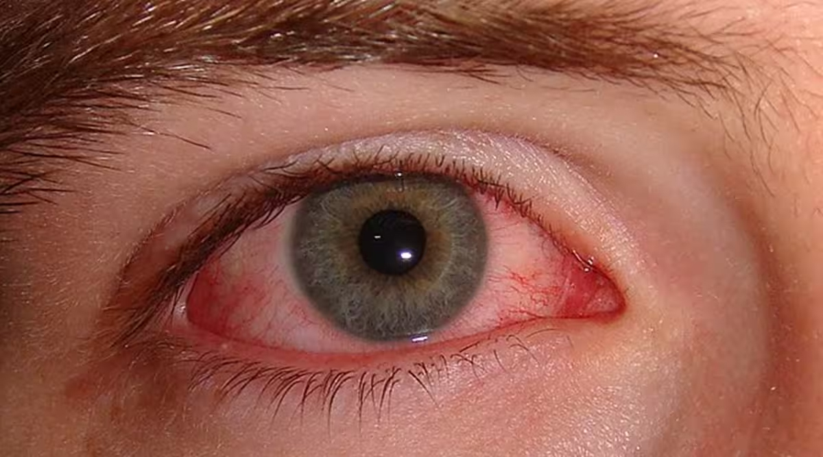 Around 15,000 cases of ‘Eye Flu’ in J&K