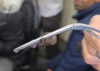 GMC Anantnag Doctors Remove Snake-Like Worm from Teenager’s Nostril